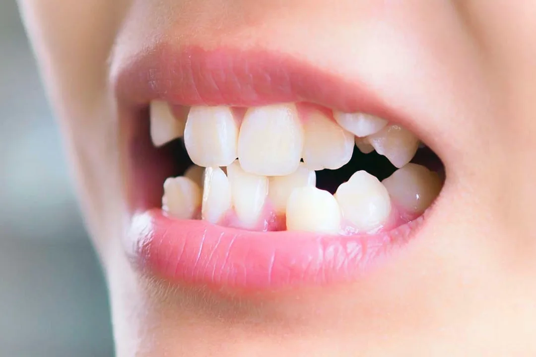 Quand envisager une chirurgie orthodontique