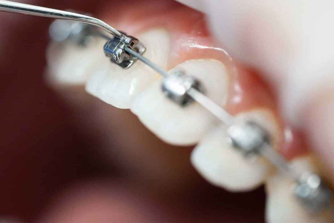 Principe de l'opération en orthodontie