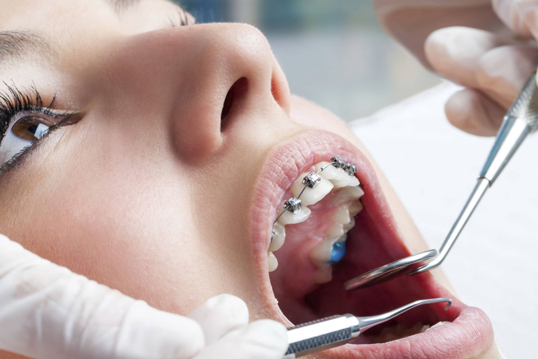 Suivi Postopératoire en Orthodontie
