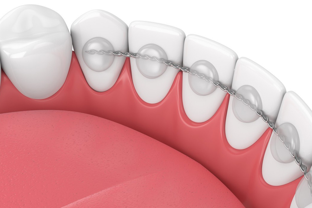 Contention en Orthodontie