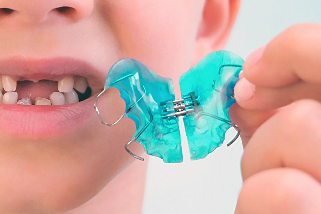 Appareils interceptifs en orthodontie